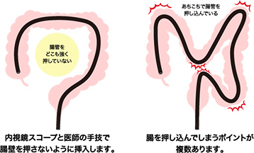 軸保持短縮法という高度な挿入法で大幅に苦痛を軽減